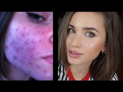 Удаляем ПОСТАКНЕ, Застойные Пятна, Проблемная Кожа, МАСКИ