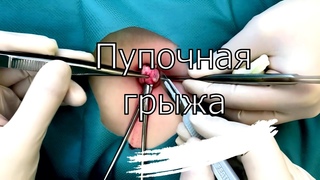 Операция при пупочной грыже